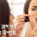 মুখের ব্রণ দূর করার উপায়